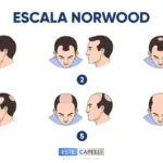 Escala de Norwood 2026: Guía Completa y Mejor Análisis