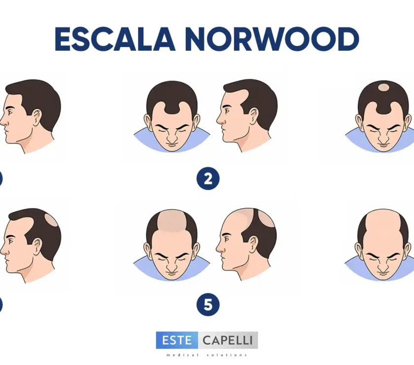 escala de norwood
