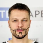 Implante de Barba Chile 2026: Guía Completa | EsteCapelli