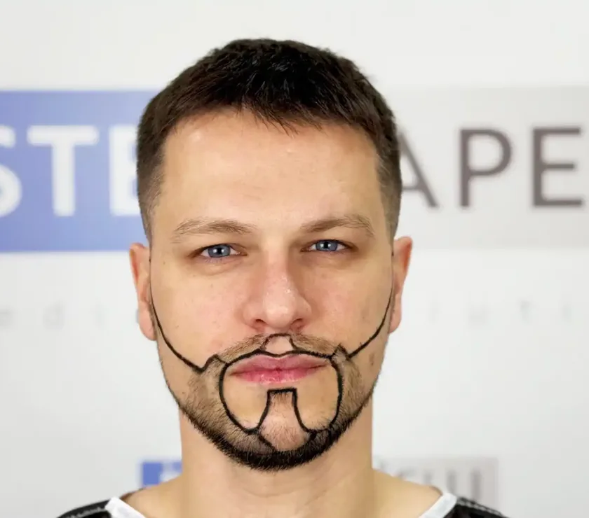 Implante de barba en Chile con técnica FUE turca en EsteCapelli Santiago