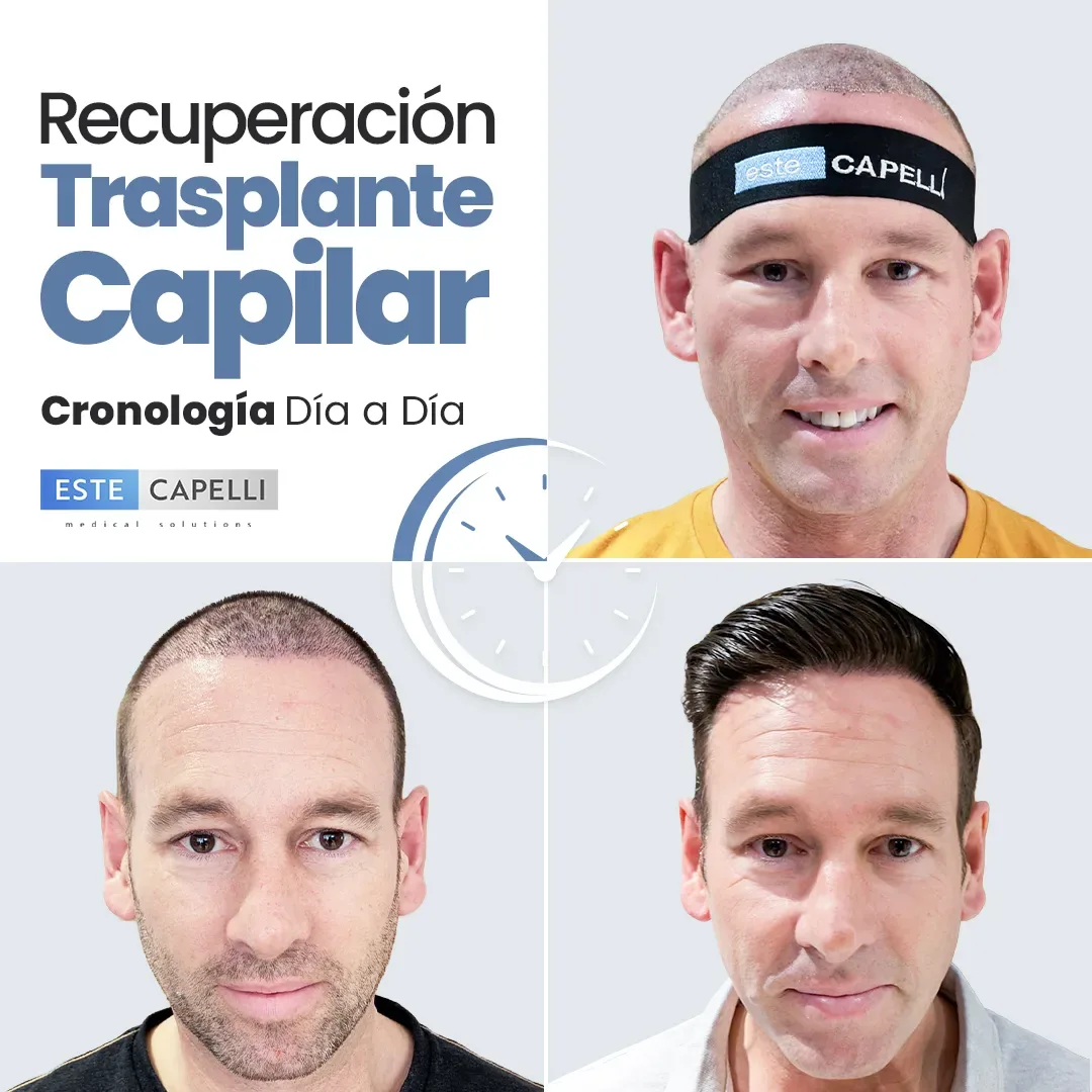 Recuperación trasplante capilar