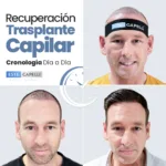Recuperación Trasplante Capilar: Guía Día a Día Mes a Mes