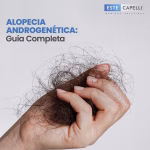 Alopecia Androgenética: Guía Completa y Mejores Tratamientos 2026