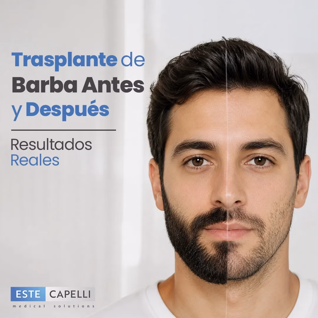 trasplante de barba antes y después