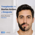 Trasplante de Barba Antes y Después: Resultados Reales en Chile