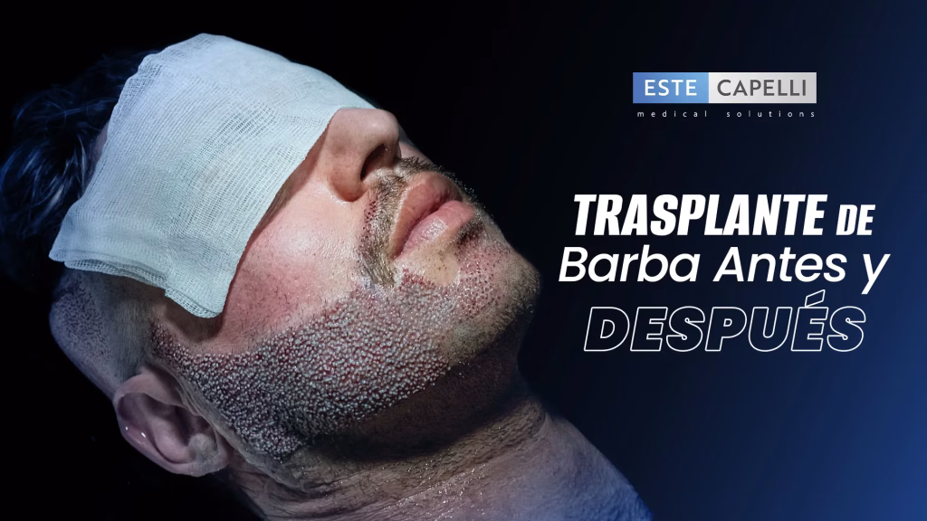trasplante de barba antes y después resultado natural con técnica FUE Vita en Estecapelli Chile